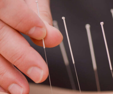 acupuncture close up