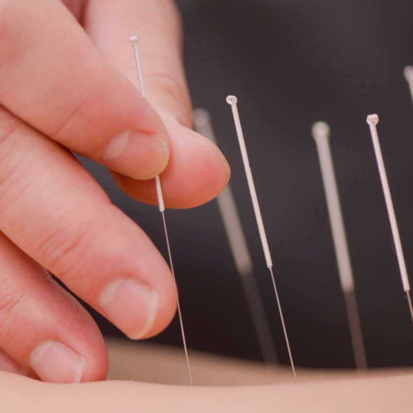 acupuncture close up